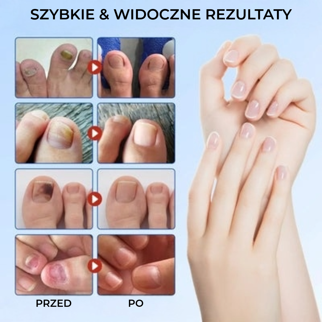 FungalPatch - Antybakteryjne Przeciwgrzybicze Plastry i Zestaw do Pielęgnacji Paznokci
